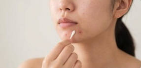 顎にできたニキビ