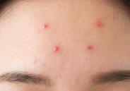 おでこにあるにきび