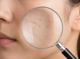 皮膚の層構造とメラニン沈着部位