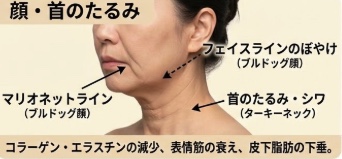 顔・首のたるみについて