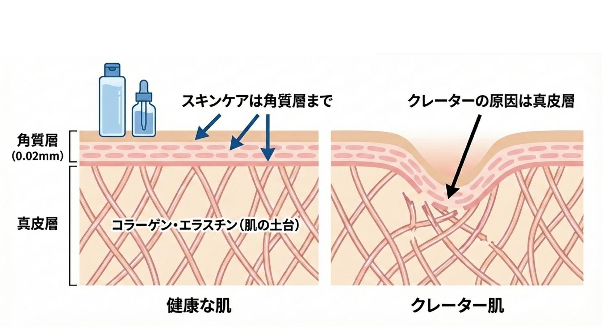 肌の構造と角質層・真皮層の説明イメージ