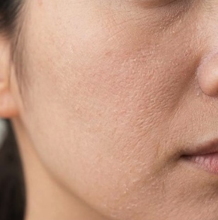 【2026年最新】女性の乾燥肌の特徴とは？年代別の原因と今日からできるケア方法