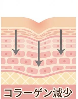 たるみの原因を図解したイラスト