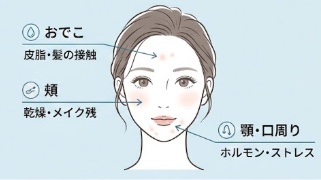 ニキビのメカニズム