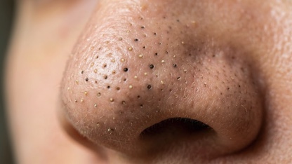 いちご鼻の角栓を「抜かず溶かす」方法とは？酵素ジェル・BHA・最新成分を徹底解説