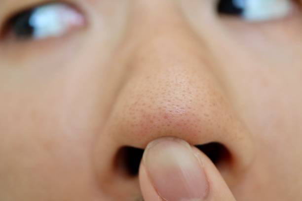 毛穴落ちのメカニズム