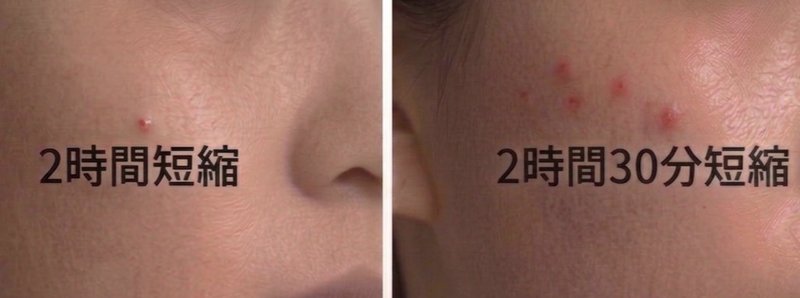 睡眠時間2時間短縮時の肌の様子